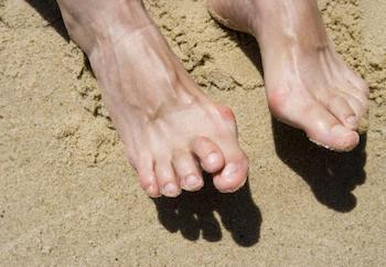 Hammer toe