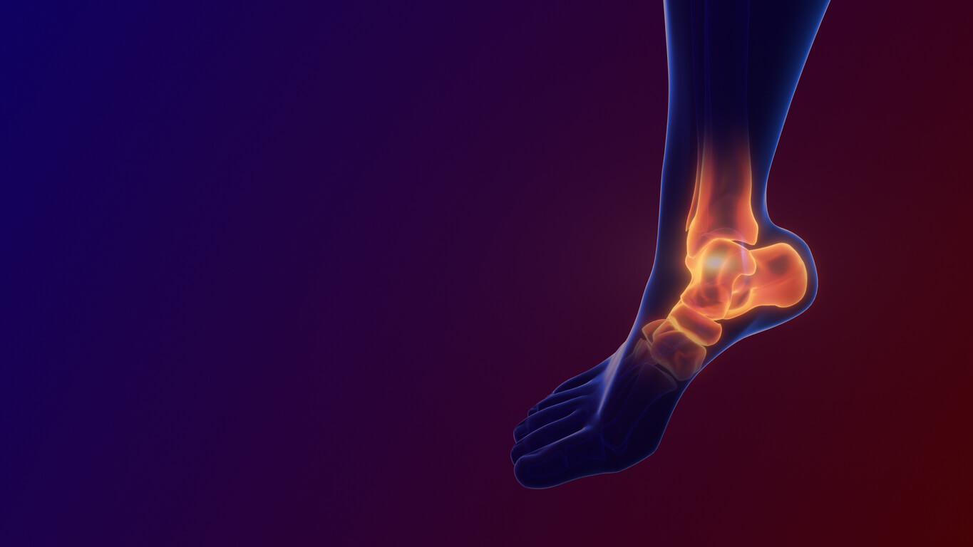 Image of Ankle Injury With Dislocation