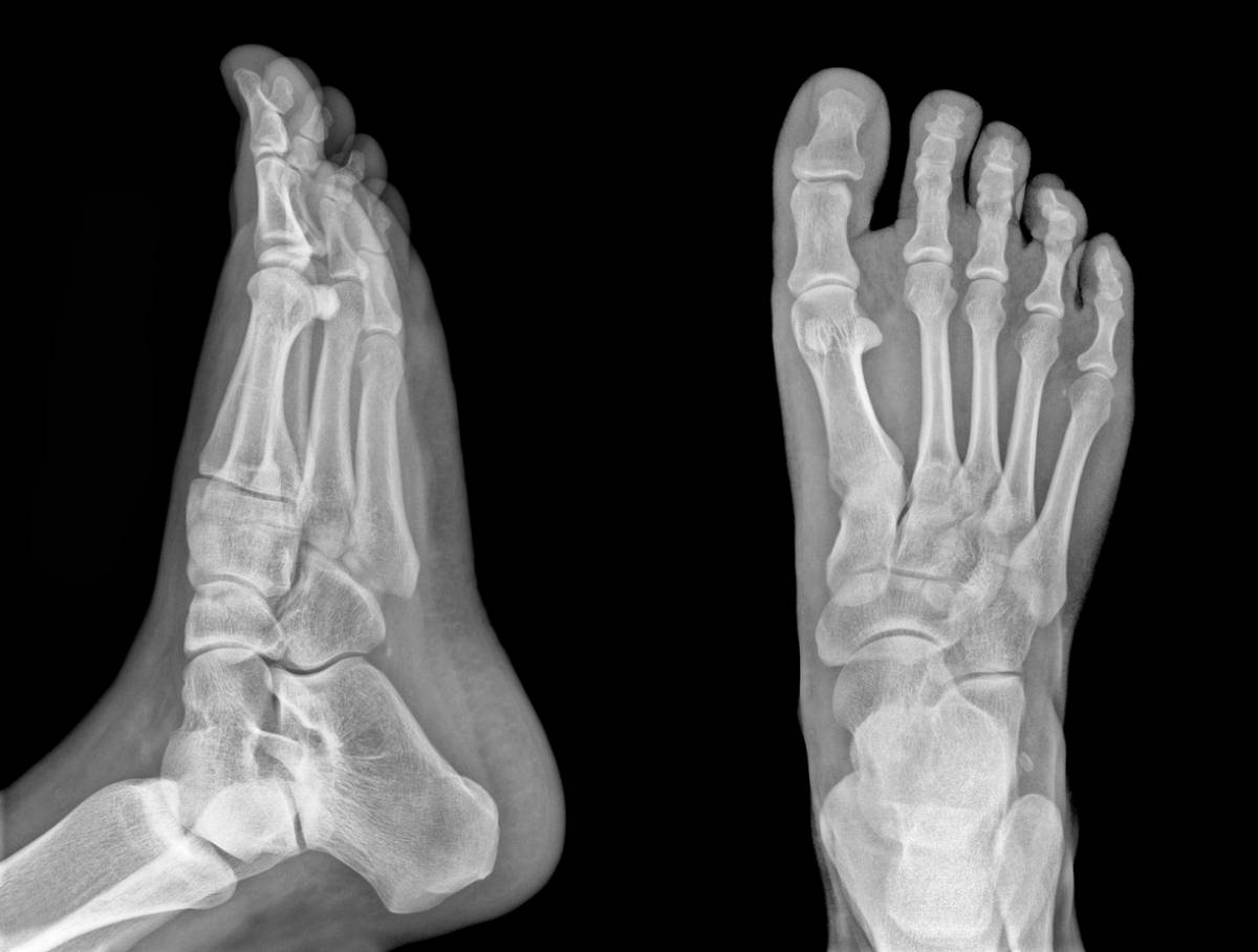 3 Signs You Should Get a Foot X-Ray
